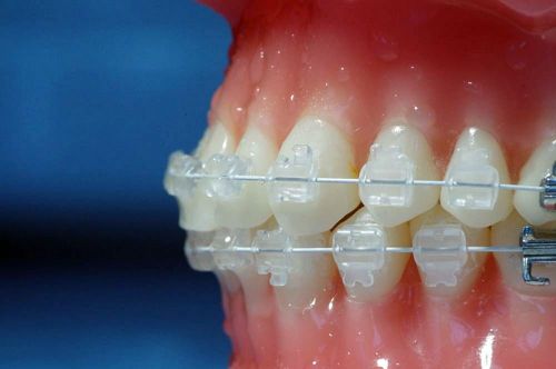 Esteticheskie-brekety11_result-e1538141524106