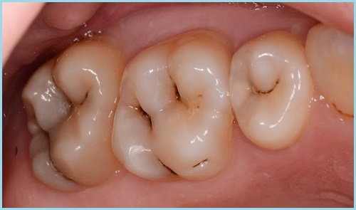 Fissurnyiy-karies-trudno-obnaruzhit-vizualno