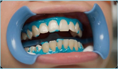 Posle-naneseniya-gelya-na-zubyi-sleduet-tri-seansa-vozdeystviya-ultrafioletom